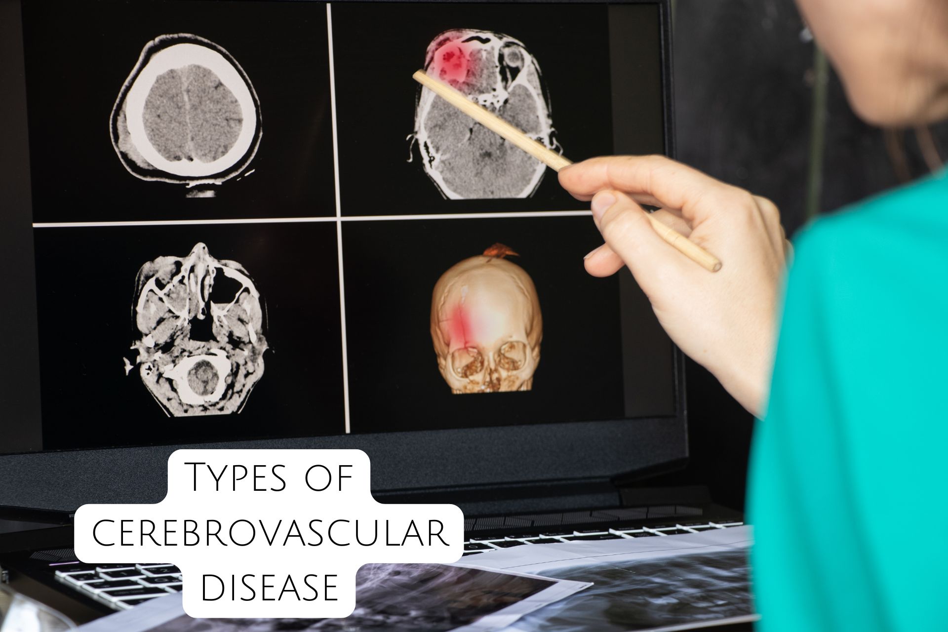 Types of cerebrovascular disease