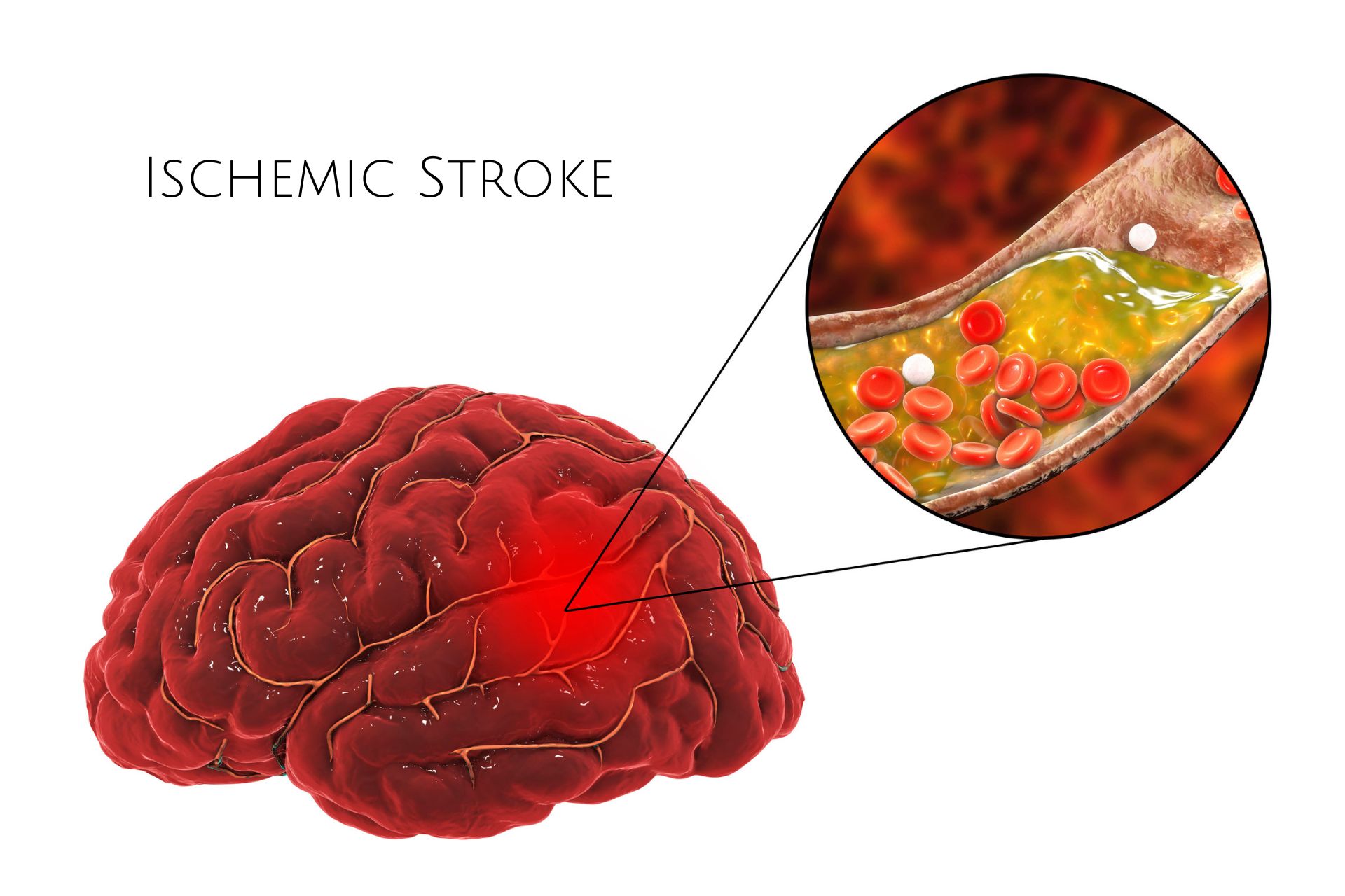 Ischemic Stroke