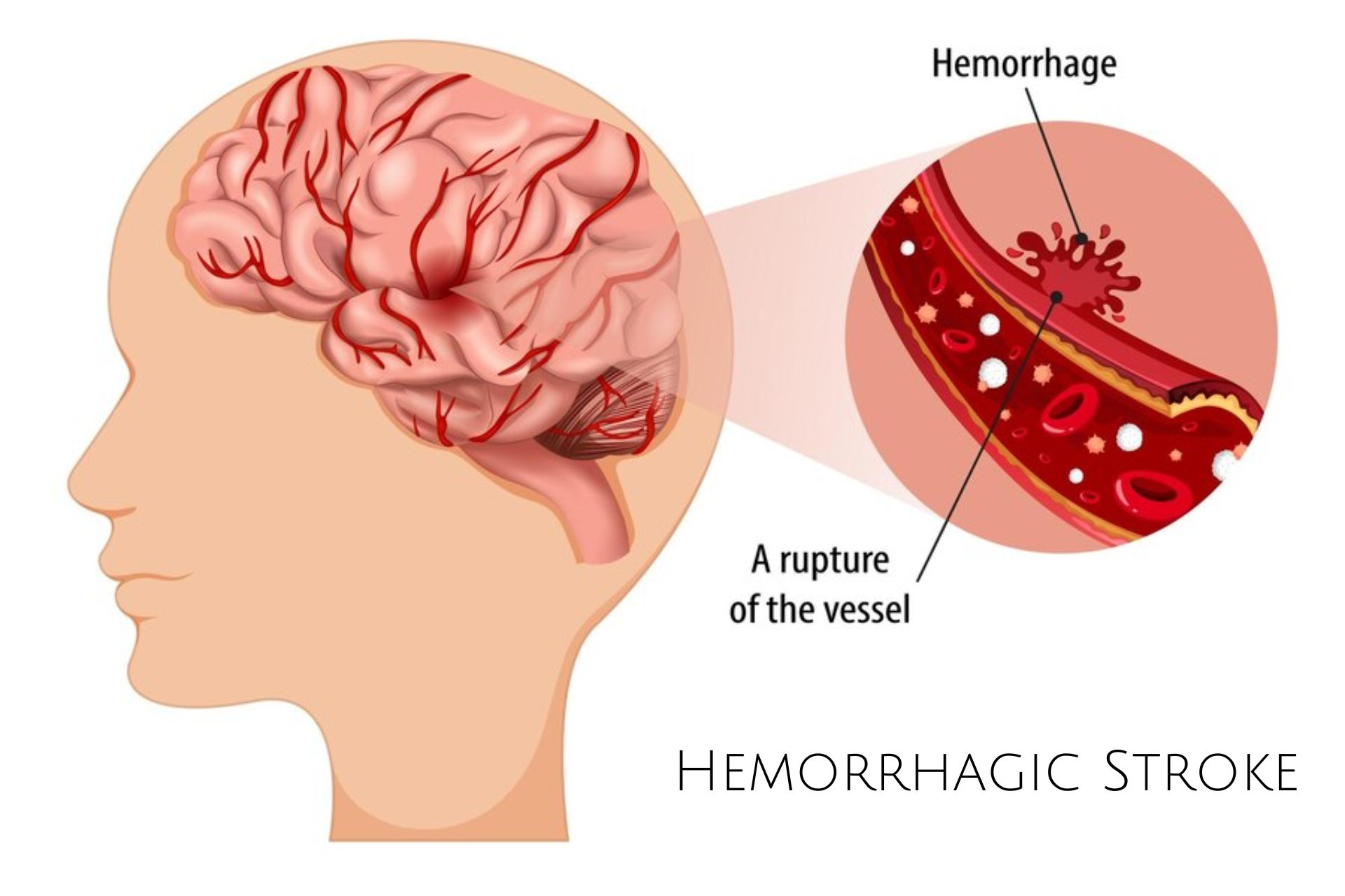 Hemorrhagic Stroke