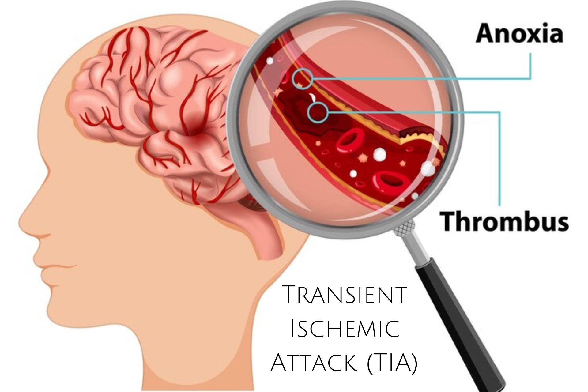 Transient Ischemic Attack (TIA)