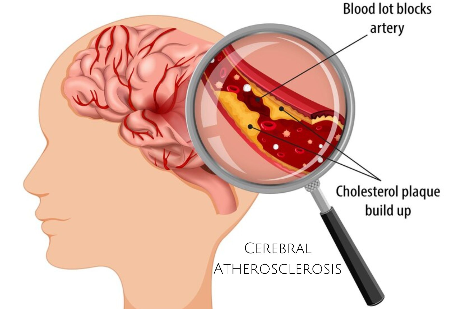 Cerebral Atherosclerosis