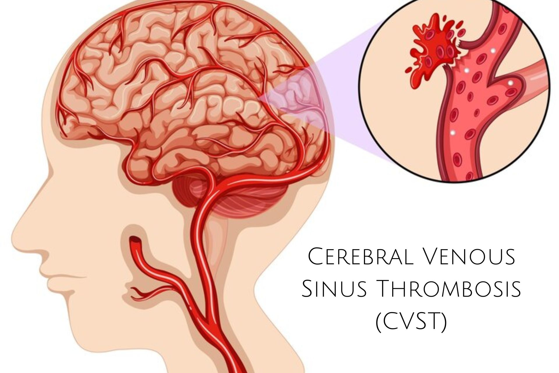 Cerebral Venous Sinus Thrombosis (CVST)